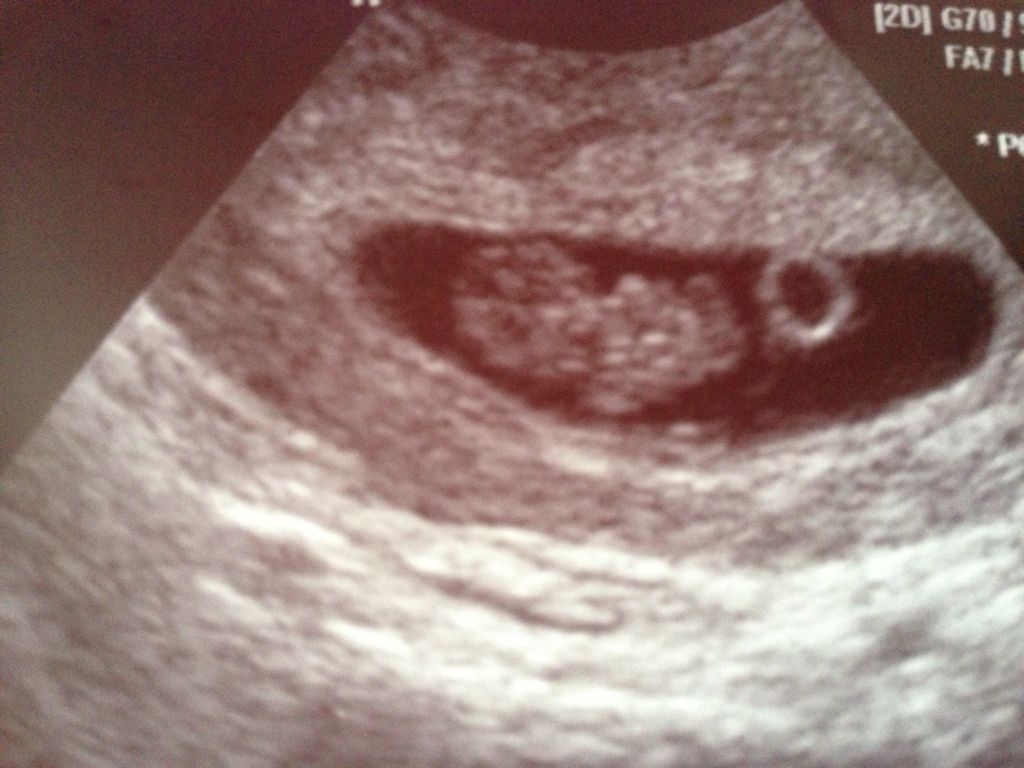 Sex of baby ultrasound pictures
